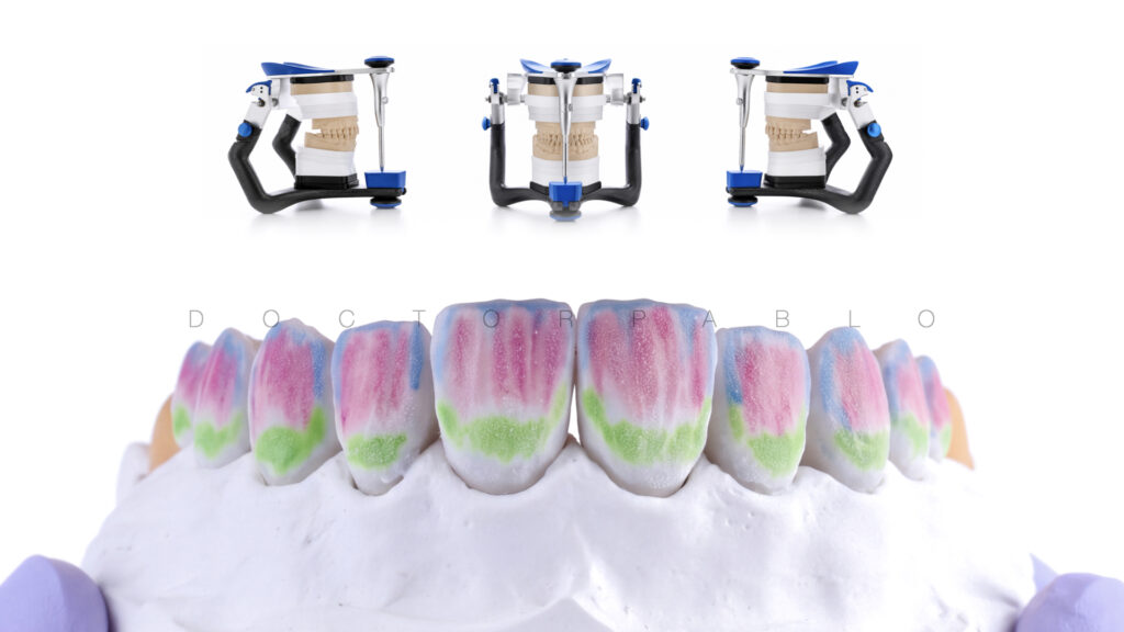 Anteior case MYZERO.014