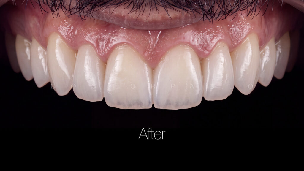 Anteior case MYZERO.015