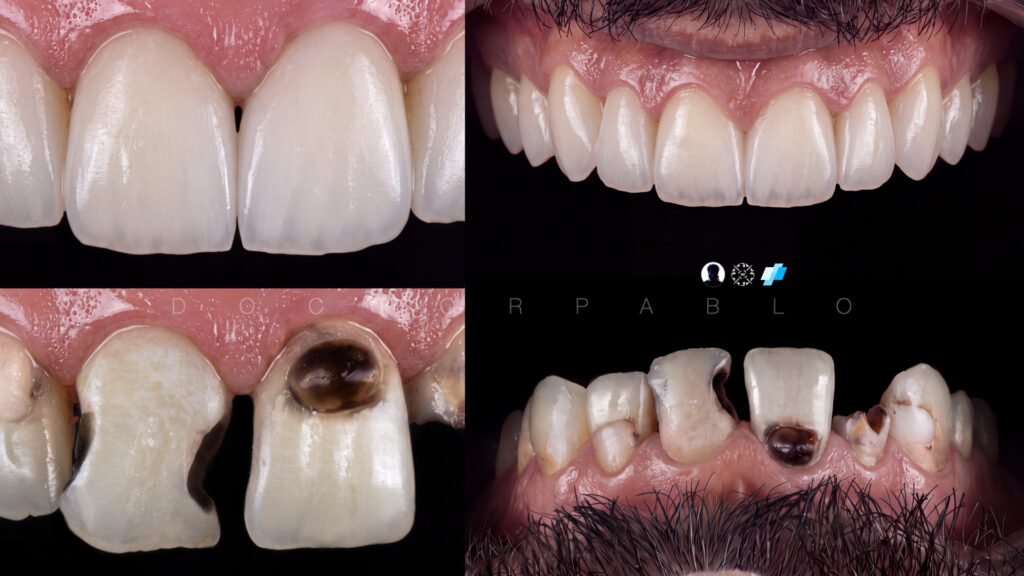 Anteior case MYZERO.016