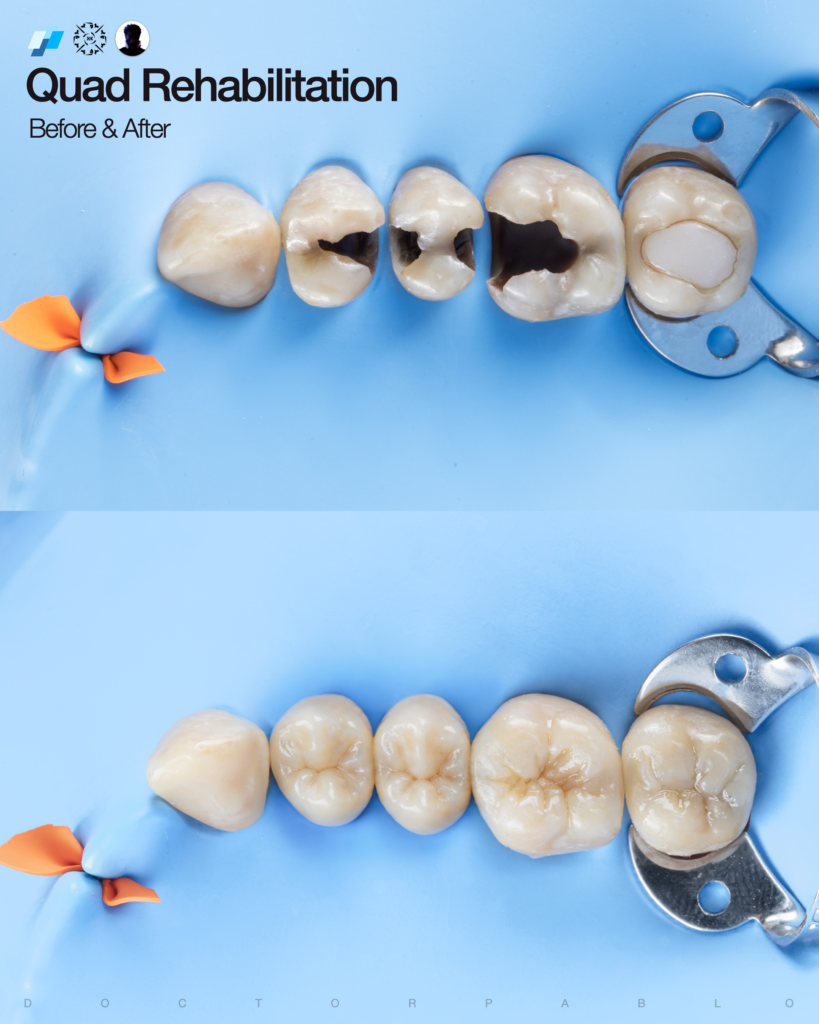 QUAD REHAB CASE.026